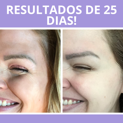 BotoxLaser - Acabe Com as Rugas em 7 dias + BRINDE EXCLUSIVO